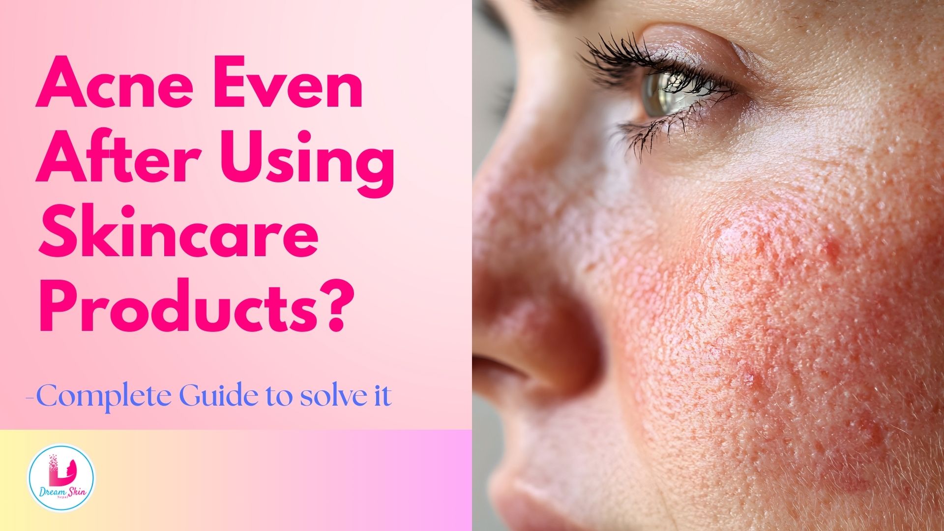 Why Do I Still Get Acne Even After Using Skincare Products?